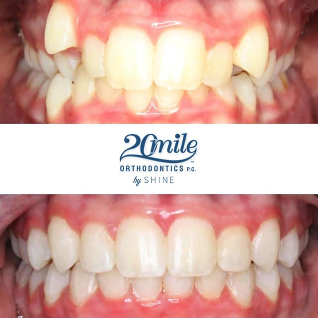 Before and after smile 1