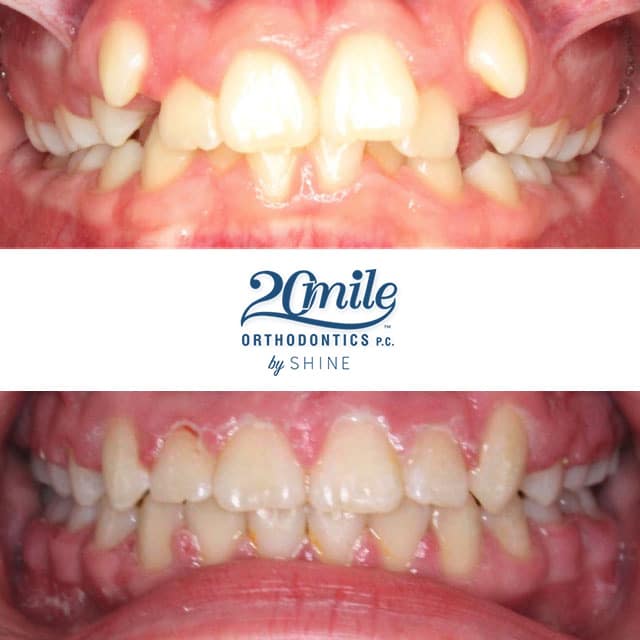 Before and after smile 2
