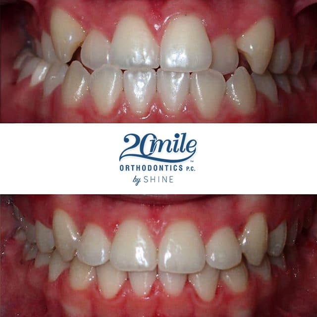 Before and after smile 3