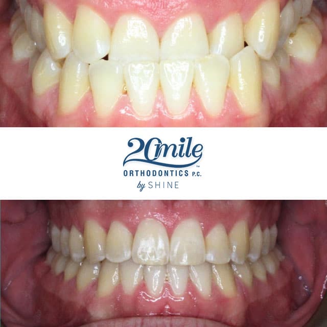 Before and after smile 4