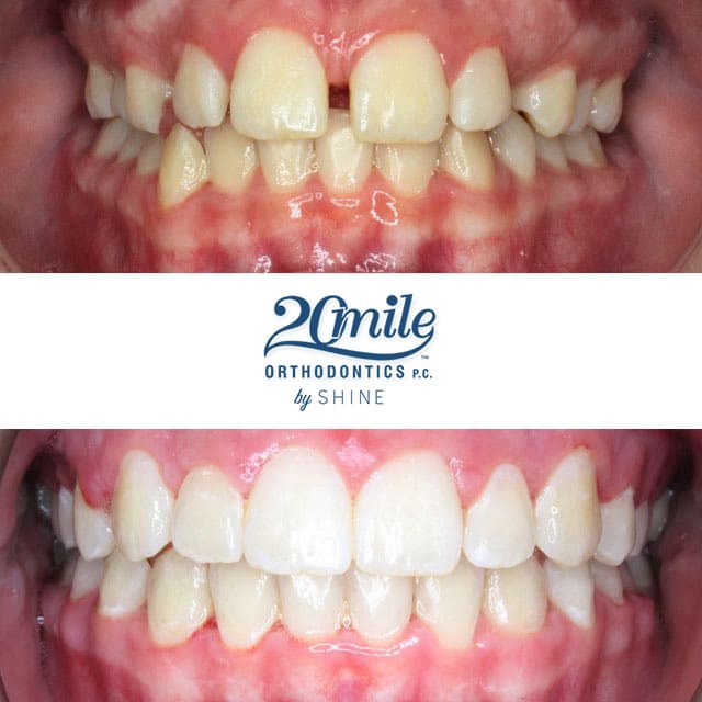 Before and after smile 5