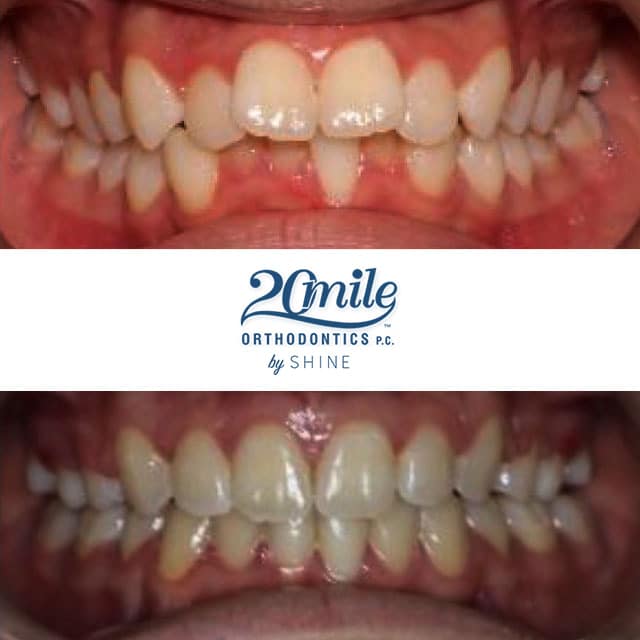 Before and after smile 6